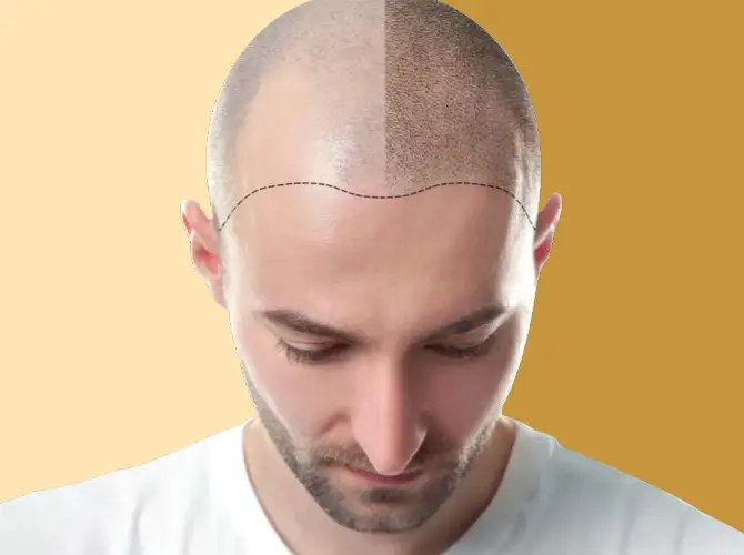 Best Hair Transplant Clinic in Delhi: To know Best Hair Clinic in Delhi visit DMC Trichology, where doctors themselves perform hair transplants.

