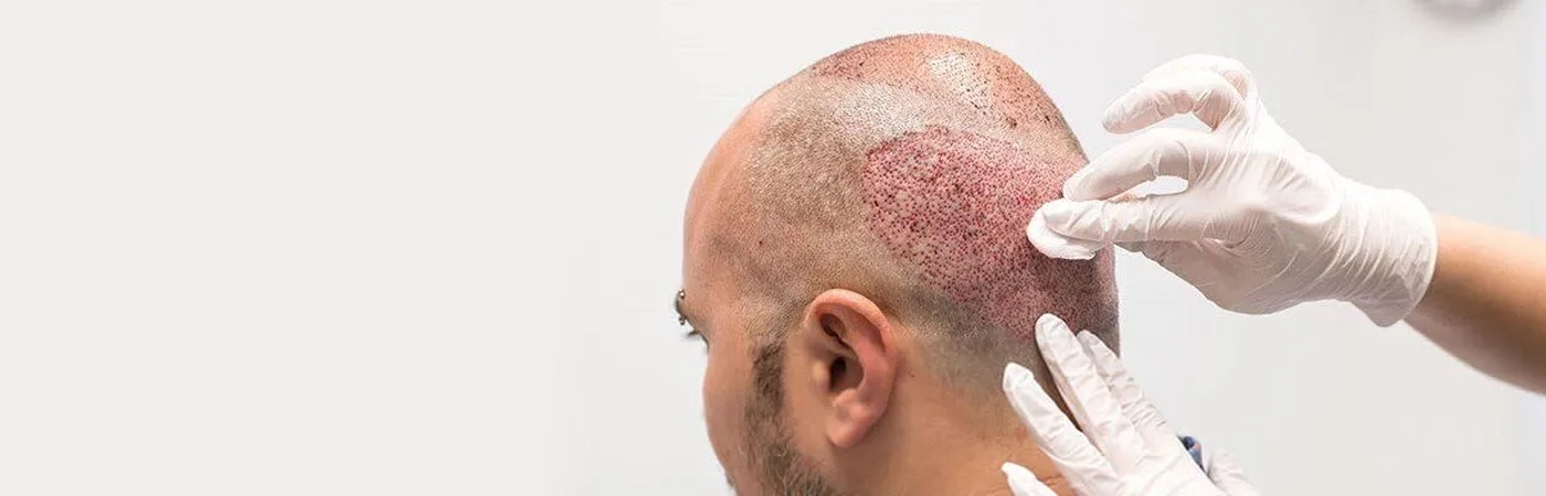 FUE Hair Transplant