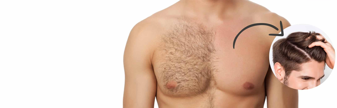 Body Hair Transplant (BHT)