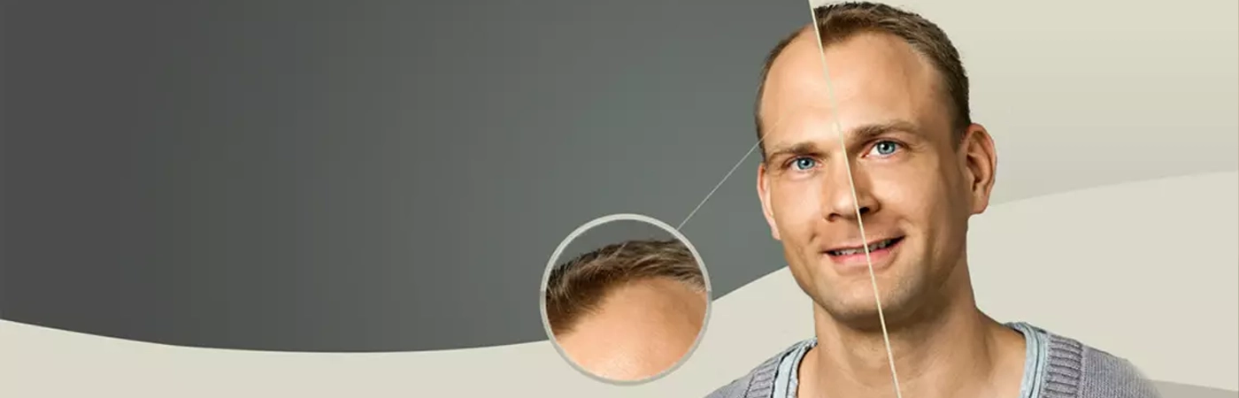 DMC - GOLDEN TOUCH HAIR TRANSPLANT TECHNIQUE®