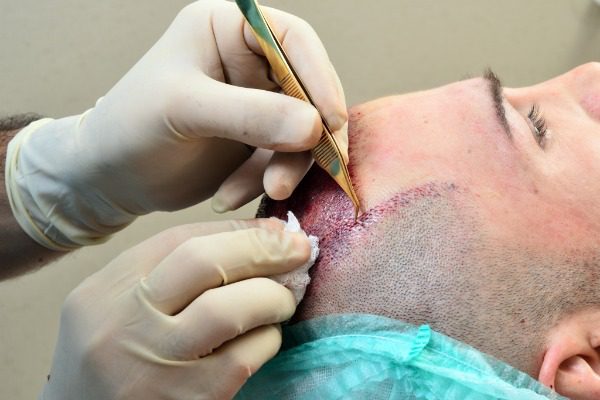 DMC Trichology provides Best Service for Hair Transplant in South Delhi Consult now! 