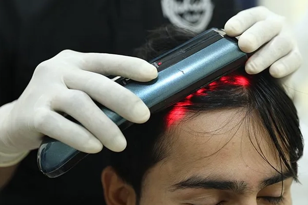 Here you know the cost of Mesotherapy for Hair Loss in Delhi. It's depends on factors like the extent and severity of baldness or hair loss