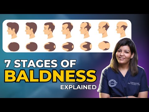 7 Stages of Baldness | Best Treatment for Baldness |PRP or Hair Transplant | Hair Transplant Surgery