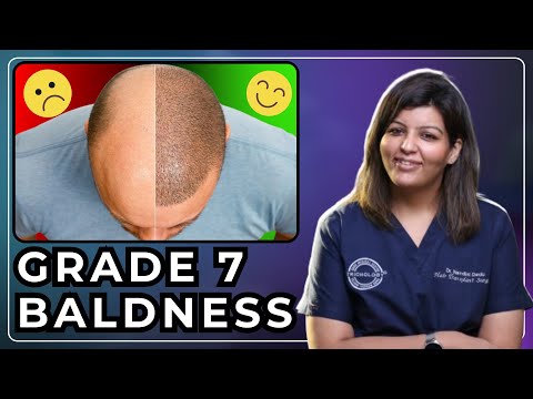 Stage 7 Baldness | Best Treatment Options for Stage 7 Baldness | Best Hair Specialist in Delhi