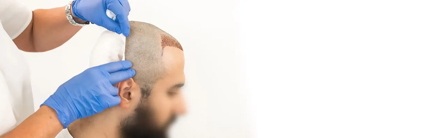 Hair transplant - procedure